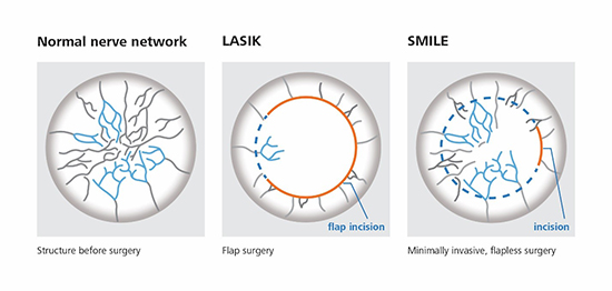 smile-or-lasik-comparing-5-aspects-of-2-vision-correction-surgeries